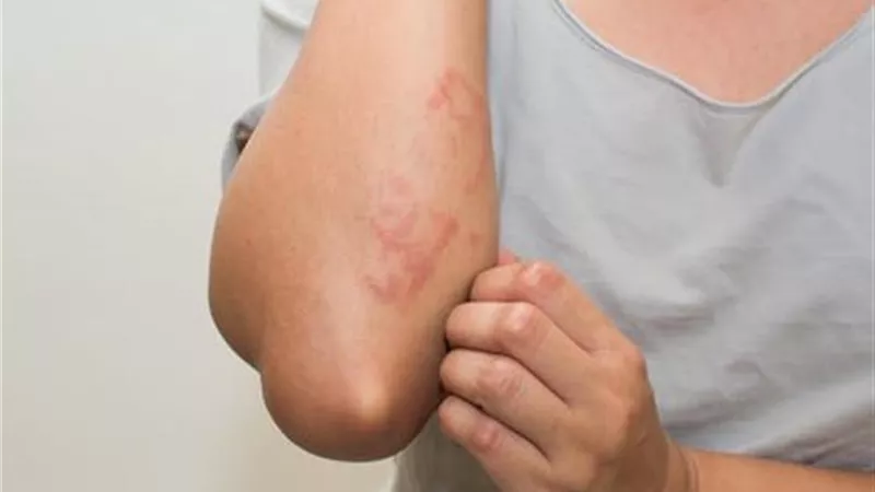 8 أطعمة تسبب الهرش والحساسية والطفح الجلدي
