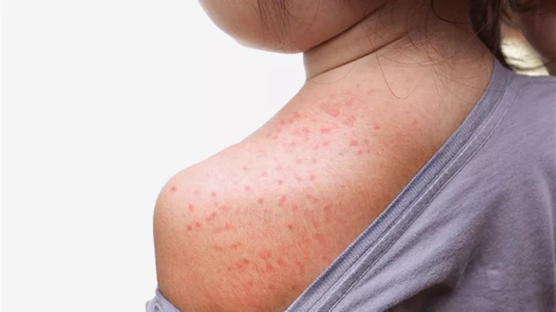مع ارتفاع درجات الحرارة.. 5 نصائح لوقاية طفلك من حمو النيل
