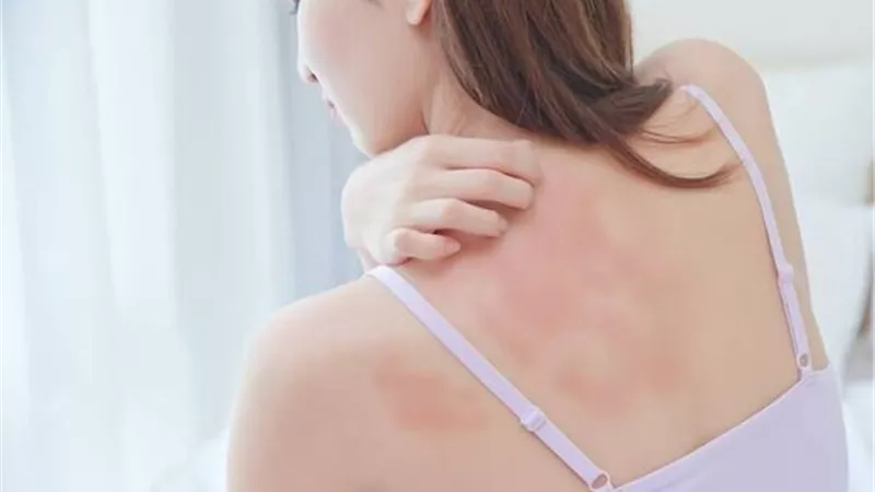 لمشاكل الحكة.. 7 علاجات منزلية لتهدئة بشرتك خلال فصل الصيف