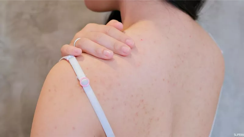 في حر الصيف.. 3 طرق طبيعية للتخلص من حب الشباب في الكتف