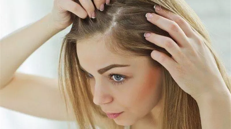 وصفات طبيعية فعالة للتخلص من قشرة الشعر