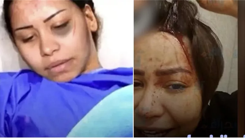 «دمائها تسيل ».. أول صورة لـ شيرين عبد الوهاب بعد اعتداء حسام حبيب عليها
