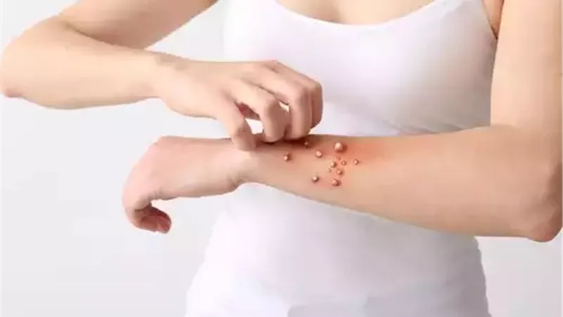 بعد تفشي جدري القرود.. 6 تدابير غذائية يجب الحرص عليها للوقاية 