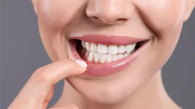 لتخفيف الألم.. 6 علاجات منزلية للتخلص من حروق الفم 