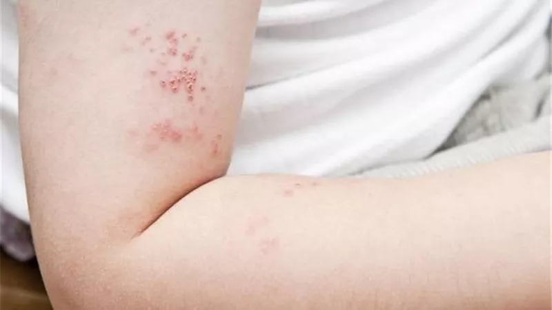 أعراض الإصابة بالحزام الناري.. وما هي مضاعفاته ومراحل الإصابة به