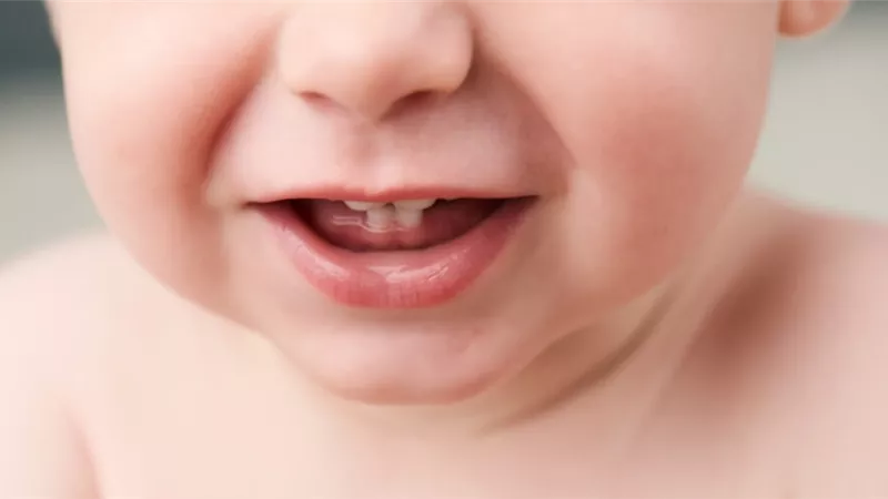 القومي للبحوث يوضح أسباب تسوس الأسنان عند الأطفال