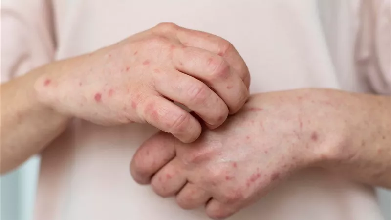 بعد ظهور أول حالة في أمريكا.. ما هي أسباب وأعراض جدري القرود؟