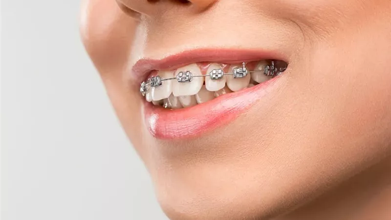 3 أنواع من الأجهزة التقويمية لعلاج الأسنان أيهما أفضل؟.. استشاري بالقومي للبحوث توضح