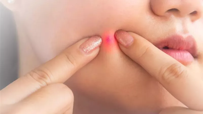 بدون أدوية أو تكلفة.. طريقة استخدام الثوم لعلاج حب الشباب