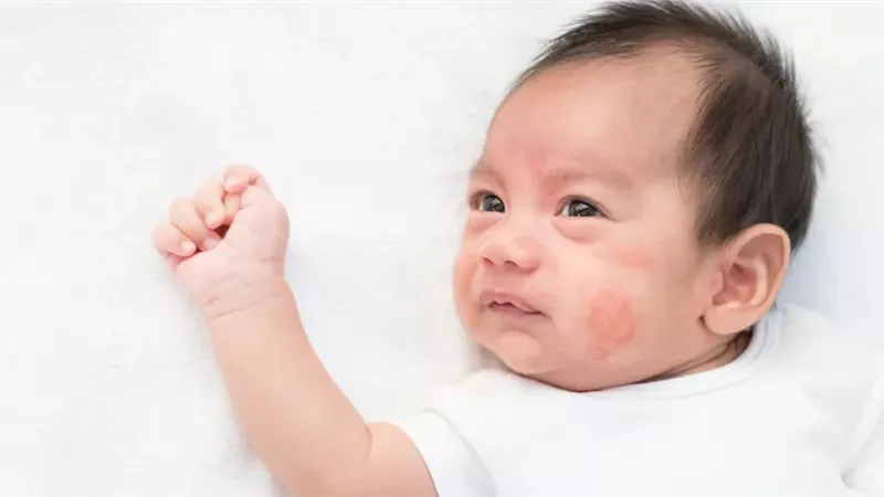 أستاذة بالقومي للبحوث يحذر الأمهات من حساسية الألبان لدي الرضع