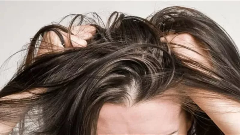 5 علاجات منزلية للتخلص من فروة الشعر الجافة  