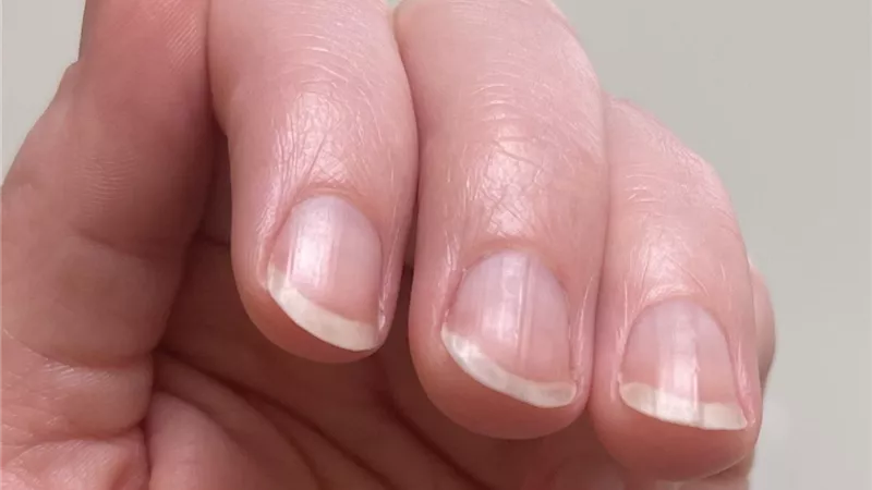 5 أسباب للإصابة بتجاعيد الأظافر و4 طرق لعلاجها