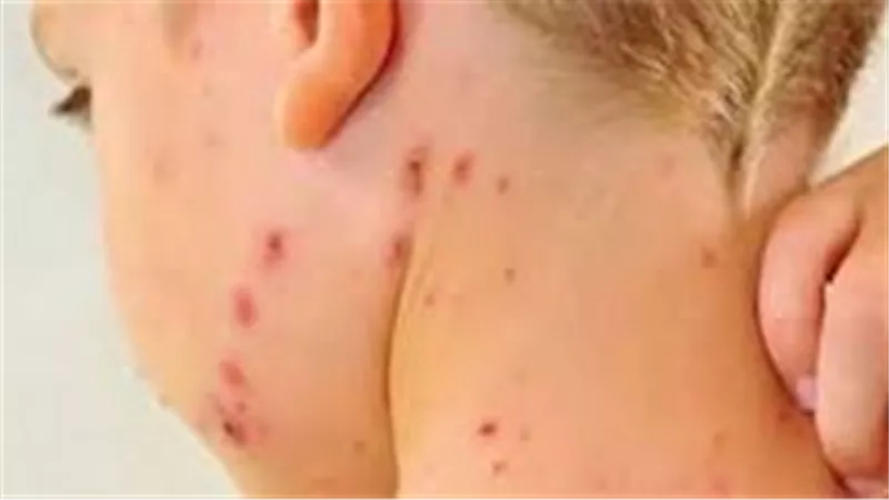 تفشي الحصبة في تكساس الأمريكية ووفاة أول طفل.. إليك أعراضها