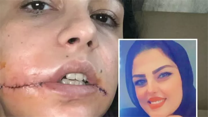 منى تستغيث: وجهي شُوّه لأنني قلت لا… فأين حقي؟