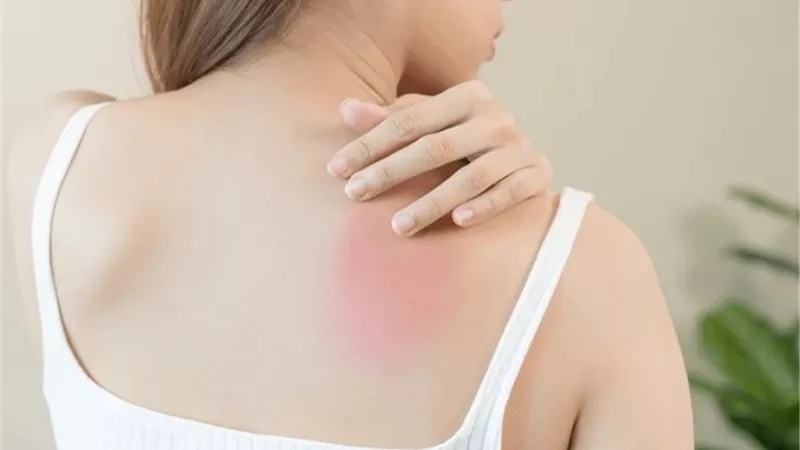 «القومي للبحوث» يكشف عن أمراض جلدية تصيب الطلاب في فترة الامتحانات