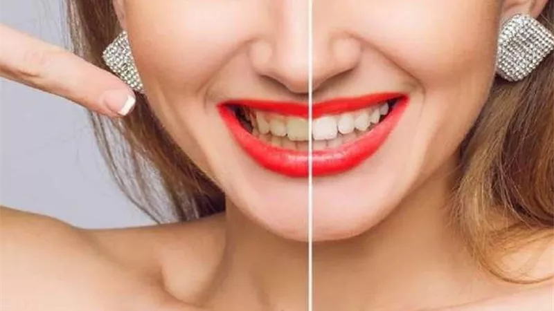 ما هي أسباب اصفرار الأسنان؟.. وزارة الصحة توضح 5 أسباب يجب تجنبها
