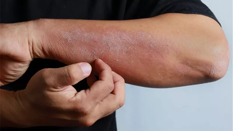 الصدفية مرض مزمن بأسباب نفسية ووراثية.. تعرّف على أبرز الأعراض وطرق العلاج الفعّالة