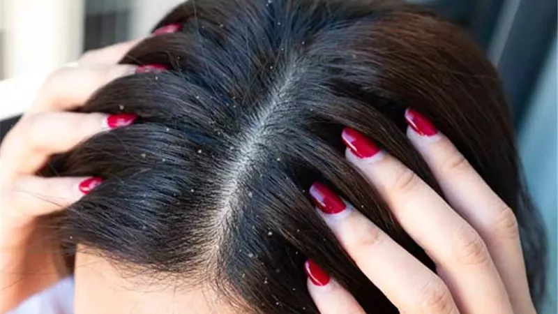 ودعي قشرة الشعر نهائيًا.. 6 حلول طبيعية من داخل منزلك 