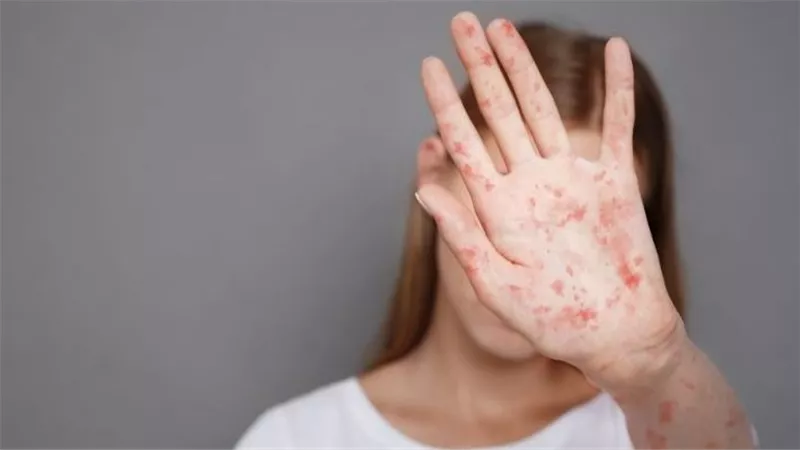 للعام الثالث على التوالي.. تجديد اعتماد مصر من منظمة الصحة العالمية كدولة خالية من الحصبة والحصبة الألمانية 