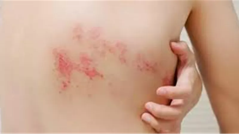 الأسبوع العالمي للتحصينات يحذر من الحزام الناري