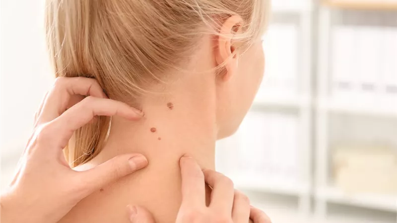 5 طرق للتخلص من الزوائد الجلدية بالمنزل.. تعرفي عليها