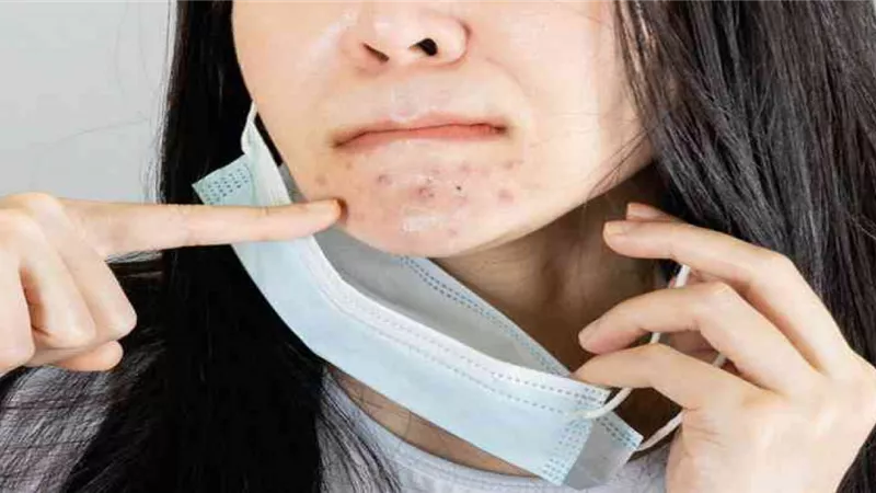 حبوب الوجه بسبب الكمامة.. ازاي تعالجيها