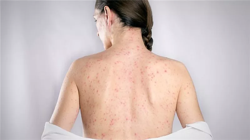 مرض الزهري.. تعرفي على أعراضه والحذر من العلاقة الحميمة أبرز وقاية