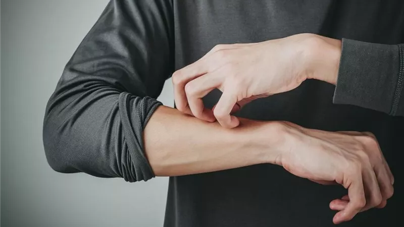 هل مرض الصدفية مُعدي ؟.. أخصائي جلدية يُجيب