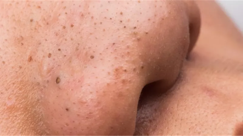 3 ماسكات طبيعية تخلصك من الرءوس السوداء فى المنزل