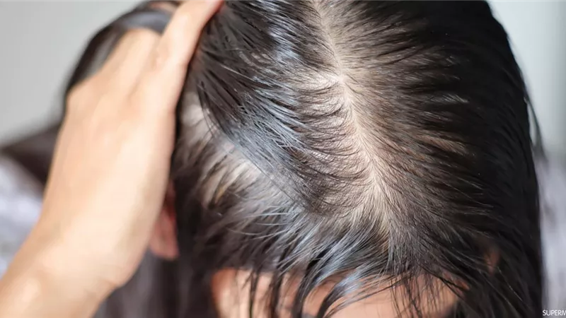 حاربي الصلع.. أطعمة منزلية تحمي شعرك من التساقط 
