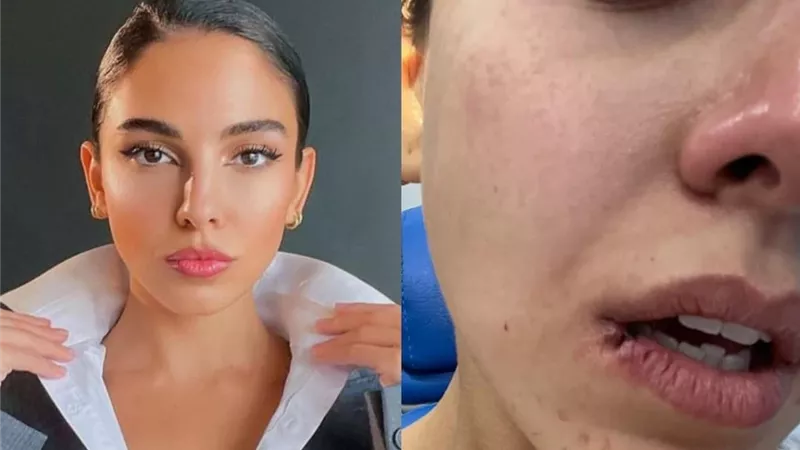 سلمى أبو ضيف تكشف عن معانتها الصحية بسبب الليزر (صور)