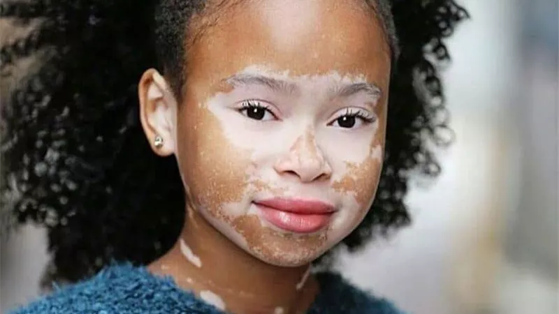 يبدأ في اليدين أولاً ثم الوجه.. استشاري أمراض جلدية تكشف 5 معلومات عن مرض البهاق| فيديو