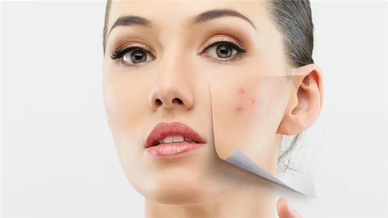 أهمها «السكريات».. 3 أطعمة تسبب حَبّ الشباب