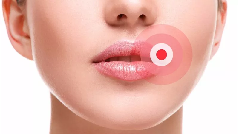 كل ما تريدين معرفته عن الهربس الفموي 
