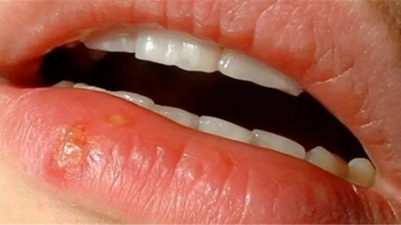 أسباب بثور الشفاه وطرق علاجها