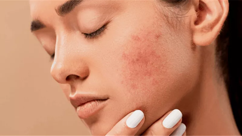 تعرفي على طرق الوقاية منها.. 5 أمراض جلدية تُصيب النساء أكثر من الرجال