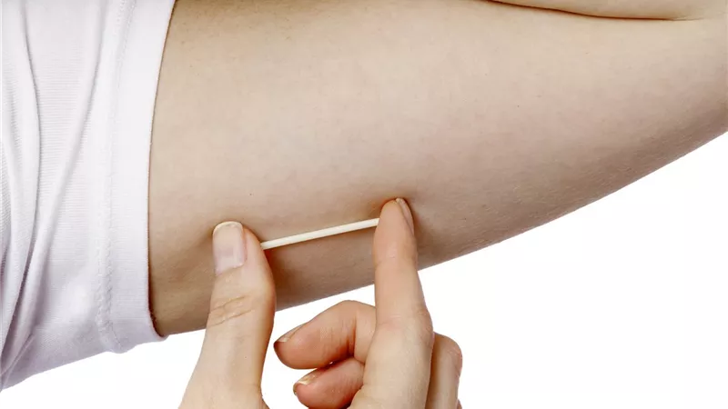 ماذا تعرفين عن شريحة منع الحمل وكيفية استخدامها؟
