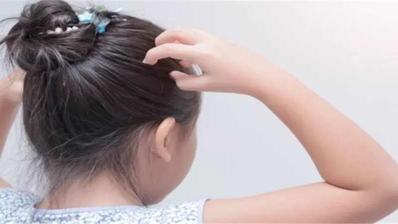 غير «القمل».. 5 أسباب لحكة الرأس عند الأطفال