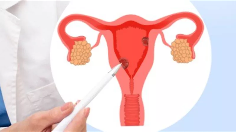 بطانة الرحم المهاجرة.. اعرفي الأعراض وطريقة العلاج 