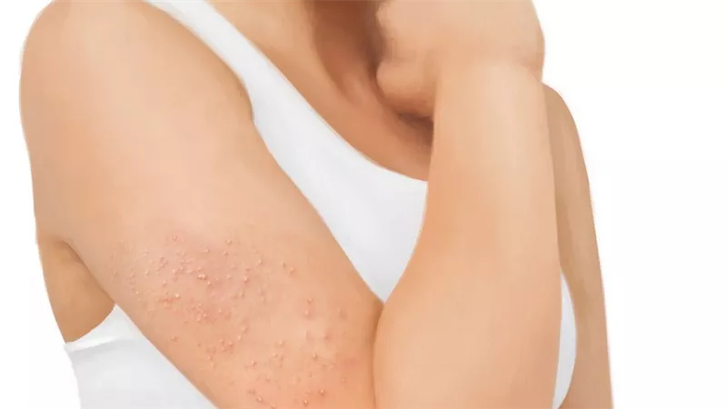 ما سبب الإصابة ببشرة «جلد الدجاج» وكيف تتخلصين منها؟