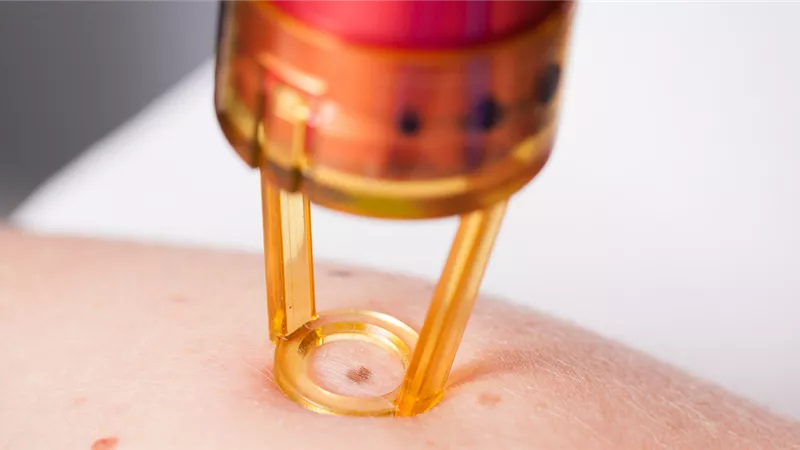 الفيروس الحليمي البشري.. احذري من عدوى فيروس hpv مع إزالة الشعر بالليزر