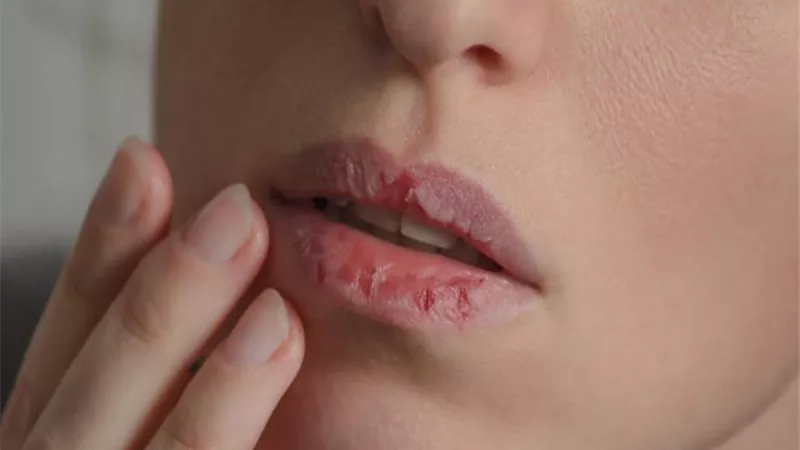 لمظهر جذاب.. كيفية معالجة تشقق الشفاه