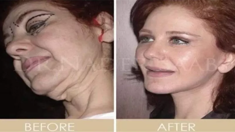ميادة الحناوي عن حقيقة خضوعها لعمليات التجميل: 