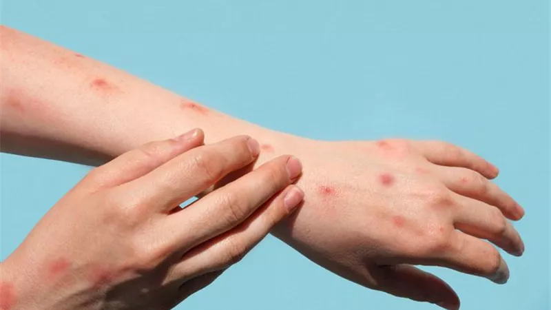 بعد انتشاره.. كيف تحمين نفسك وأسرتك من جدري القرود؟ 