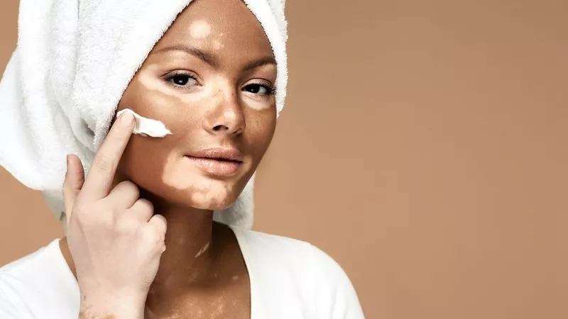 لأول مرة.. علاج موضعي فعال لمرض البهاق