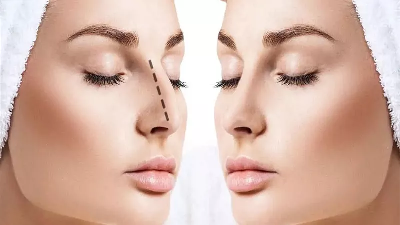 هل عمليات التجميل تبطل عقد الزواج؟.. قانوني يوضح