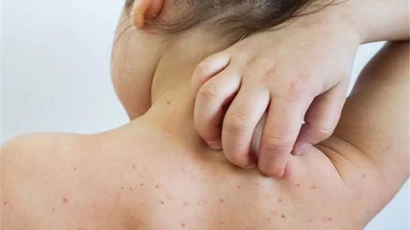 بعد إصابة مخالط.. تعرفي على أعراض جُدري القرود
