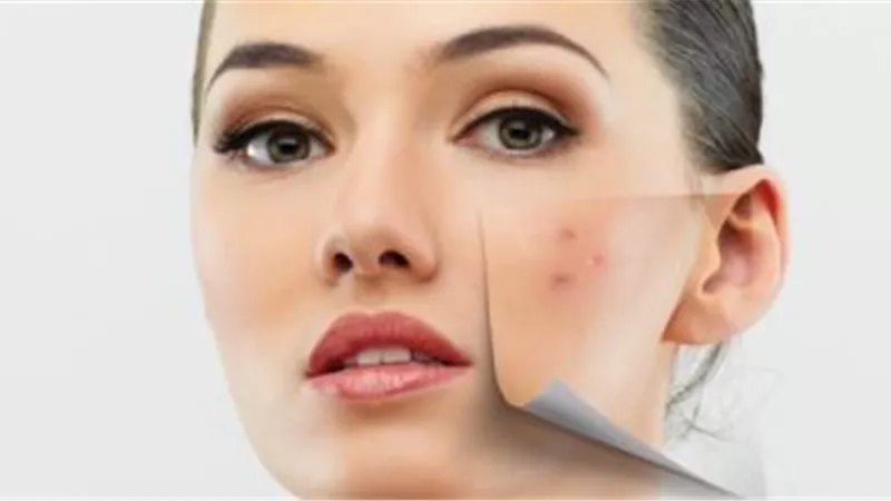 طرق استخدام قناع العسل والقرفة لعلاج بثور الوجه