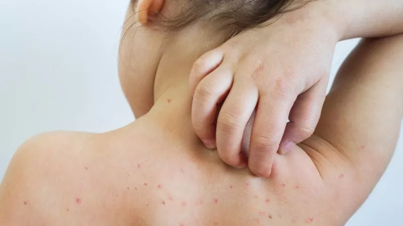 كيف يصاب طفلك بالحصبة وما طرق انتشارها والوقاية؟