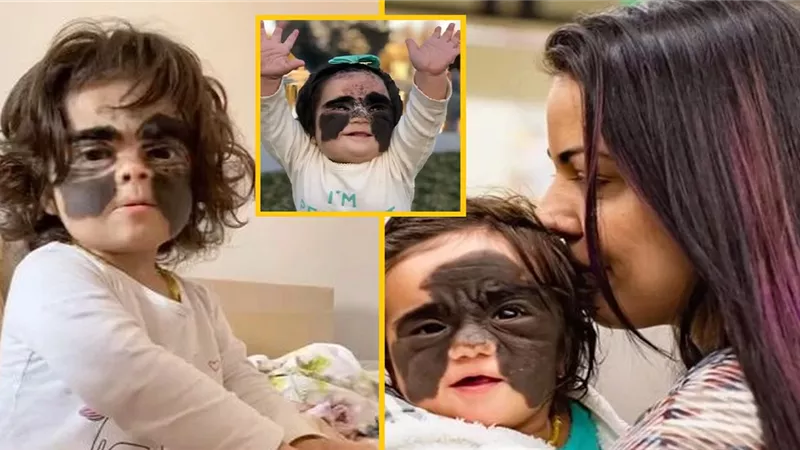طفلة تولد بوجه الرجل الوطواط «باتمان» وتلقب بالفتاة الوحش